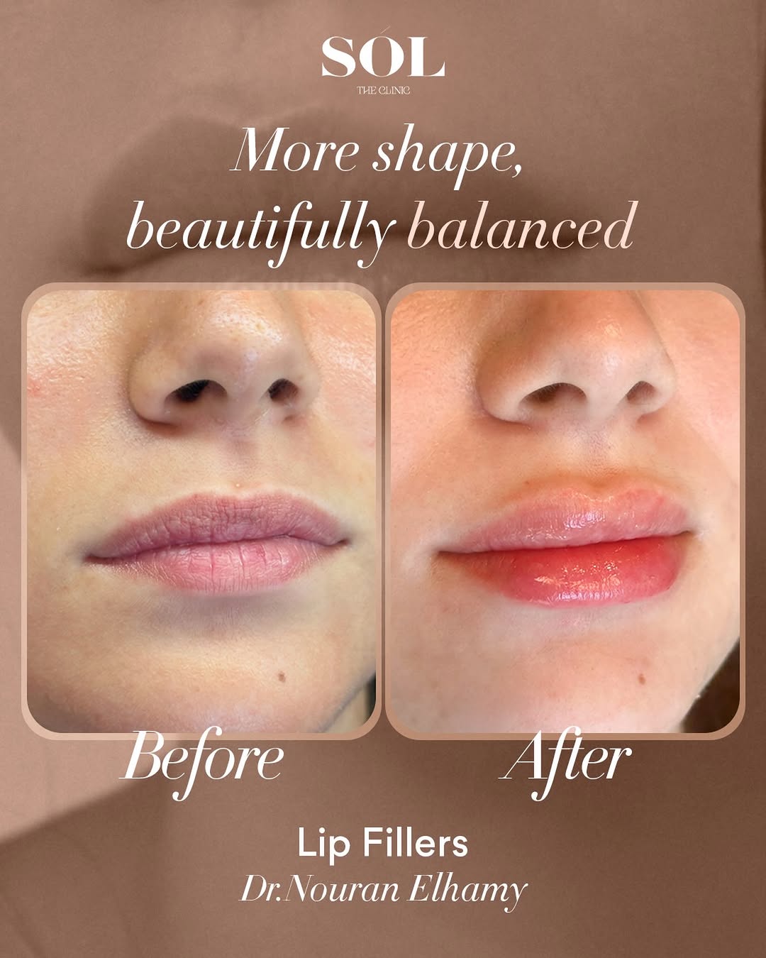 Before and after lip filler result at SÓL The Clinic