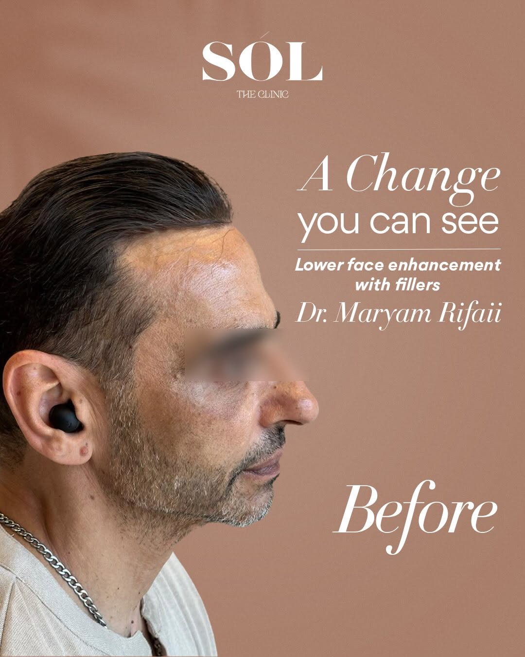 Lower face filler enhancement before photo at SÓL